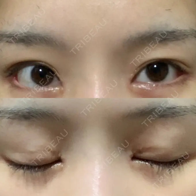 目頭切開 / 目尻切開 新宿ラクル美容外科クリニック 新宿院 DAY 19 メイン用