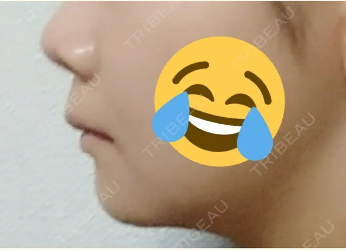 骨切り（あご） / ルフォー+ssro（両あご) id（アイディ）美容外科 DAY 31 メイン用