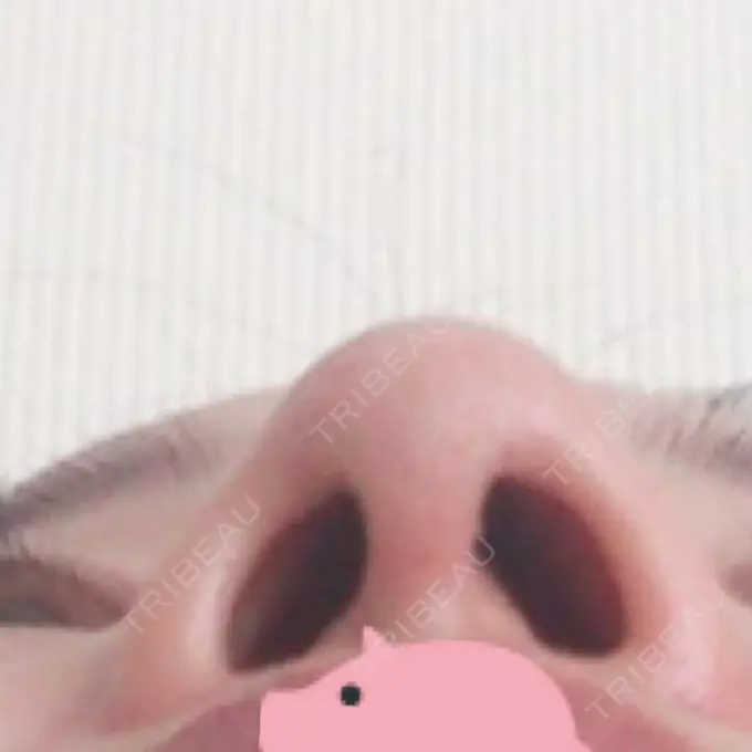 隆鼻術 / 鼻尖形成（切開） / 鼻中隔延長（切開） / 骨切幅寄せ / ワシ鼻修正・ハンプ切除 / ヒアルロン酸溶解 ミナ美容外科 DAY 119 メイン用