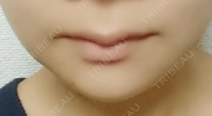 骨切り（あご） / ルフォー+ssro（両あご) id（アイディ）美容外科 DAY 31 メイン用