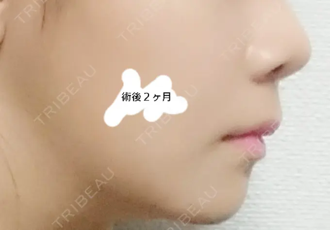 骨切り（あご） / ルフォー+ssro（両あご) id（アイディ）美容外科 DAY 61 メイン用