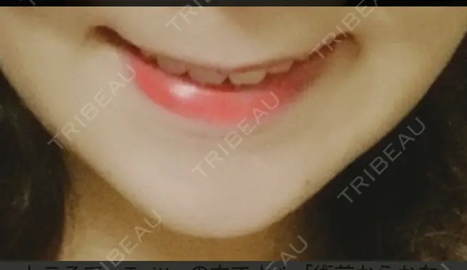 骨切り（あご） / ルフォー+ssro（両あご) id（アイディ）美容外科 DAY 61 メイン用