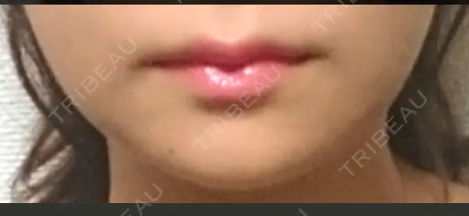 骨切り（あご） / ルフォー+ssro（両あご) id（アイディ）美容外科 DAY 61 メイン用