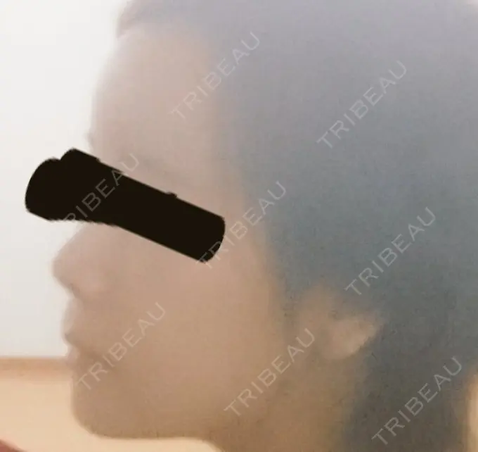 骨切り（あご） / ルフォー+ssro（両あご) id（アイディ）美容外科 DAY 99 メイン用