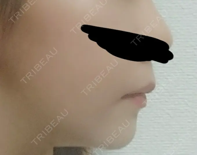 骨切り（あご） / ルフォー+ssro（両あご) id（アイディ）美容外科 DAY 122 メイン用