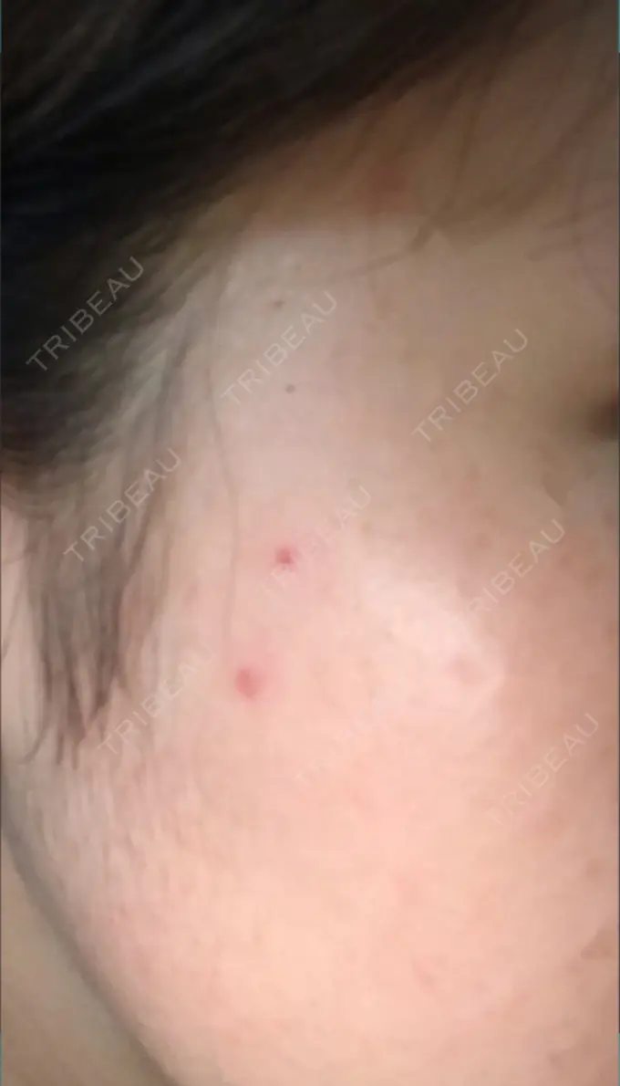 ほくろ・いぼ切除（肌） シンシアガーデンクリニック 太田院 DAY 18 メイン用