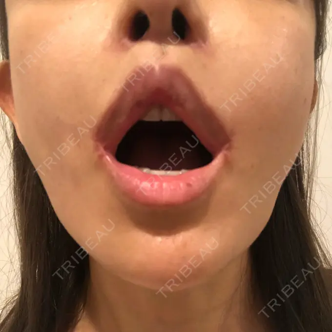 人中短縮 / 口角挙上 清潭女神美容外科 DAY 18 メイン用