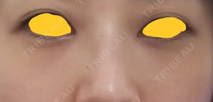 クマ治療 韓国ST美容整形外科 DAY 46 メイン用