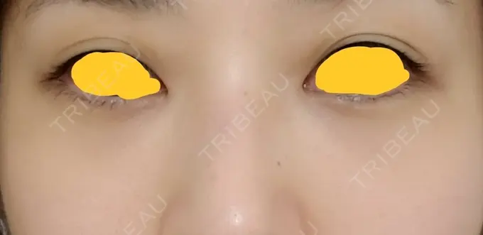 クマ治療 韓国ST美容整形外科 DAY 46 メイン用