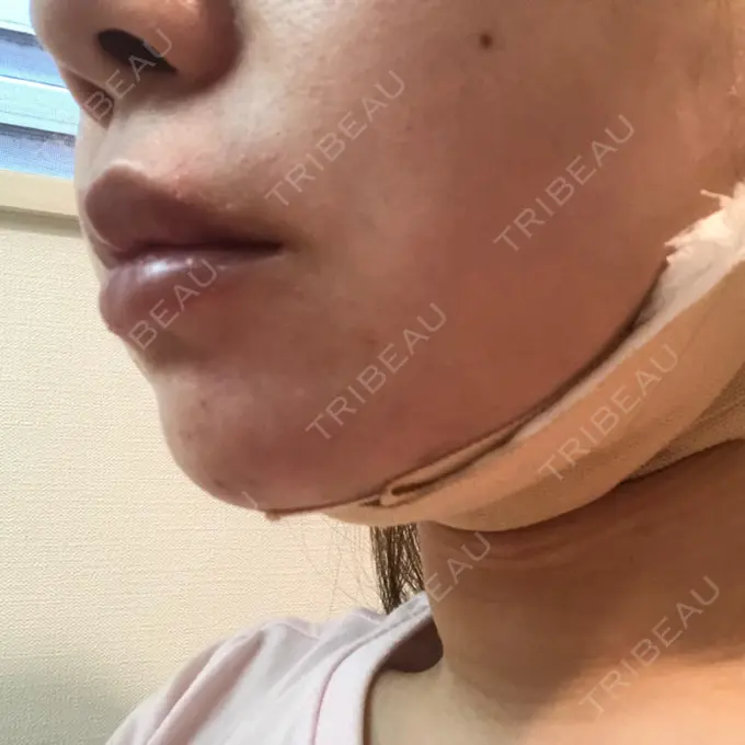 二重埋没 / 糸リフト / 脂肪吸引（顔） / ボトックス（あご） / ヒアルロン酸注入（あご） TCB東京中央美容外科 新宿東口院 DAY 2 メイン用