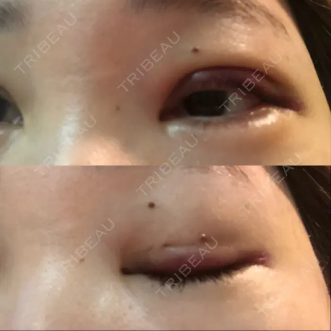 二重埋没 / 糸リフト / 脂肪吸引（顔） / ボトックス（あご） / ヒアルロン酸注入（あご） TCB東京中央美容外科 新宿東口院 DAY 2 メイン用