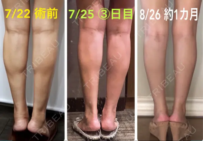 ボトックス（ふくらはぎ） REYOUNGクリニック DAY 35 メイン用