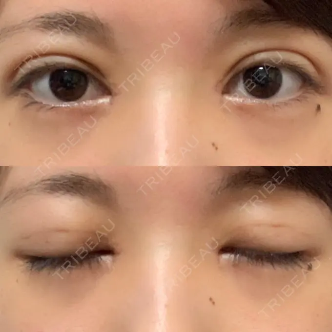 二重埋没 / 目頭切開 / 眼瞼下垂（切開） / その他（目元） 湘南美容クリニック 仙台院 DAY 14 メイン用