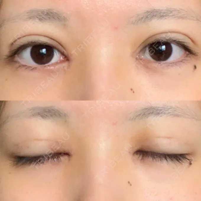 二重埋没 / 目頭切開 / 眼瞼下垂（切開） / その他（目元） 湘南美容クリニック 仙台院 DAY 16 メイン用