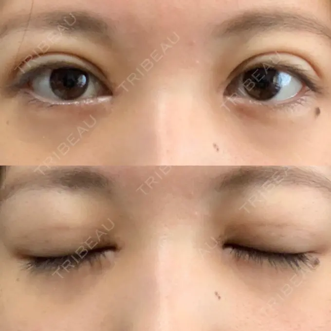 二重埋没 / 目頭切開 / 眼瞼下垂（切開） / その他（目元） 湘南美容クリニック 仙台院 DAY 17 メイン用