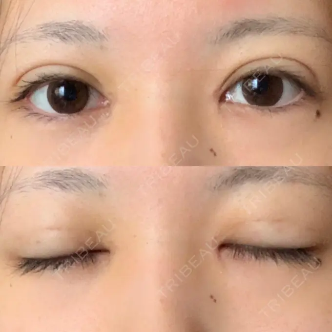 二重埋没 / 目頭切開 / 眼瞼下垂（切開） / その他（目元） 湘南美容クリニック 仙台院 DAY 19 メイン用
