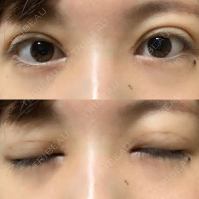 二重埋没 / 目頭切開 / 眼瞼下垂（切開） / その他（目元） 湘南美容クリニック 仙台院 DAY 21 メイン用