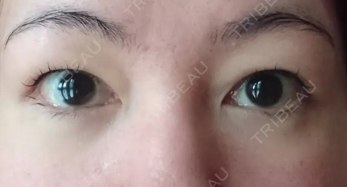 クマ治療 / 下まぶたたるみ取り / 下まぶたの脂肪取り / 脂肪注入（肌） コスメディカルクリニック シンシア 銀座院 DAY 16 メイン用