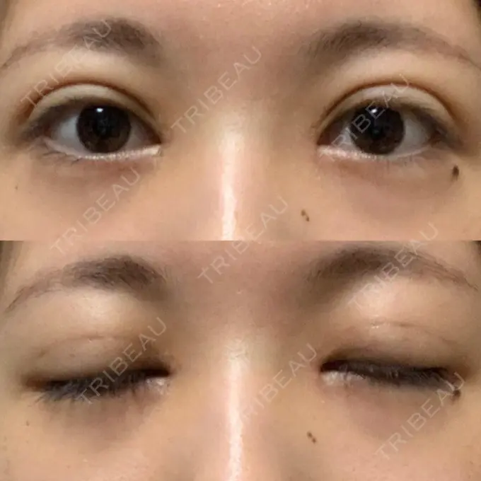 二重埋没 / 目頭切開 / 眼瞼下垂（切開） / その他（目元） 湘南美容クリニック 仙台院 DAY 22 メイン用