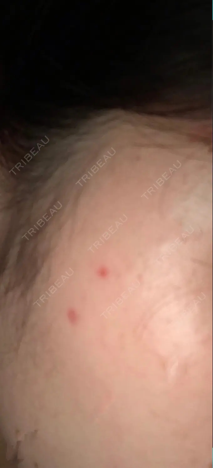 ほくろ・いぼ切除（肌） シンシアガーデンクリニック 太田院 DAY 19 メイン用