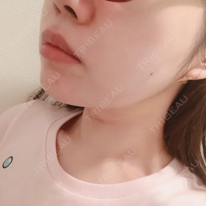 二重埋没 / 糸リフト / 脂肪吸引（顔） / ボトックス（あご） / ヒアルロン酸注入（あご） TCB東京中央美容外科 新宿東口院 DAY 2 メイン用