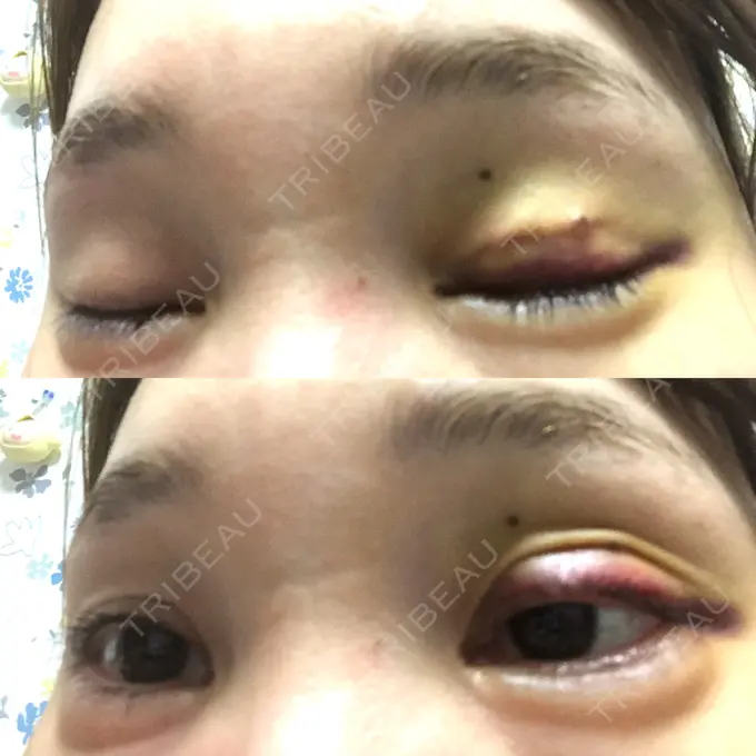 二重埋没 / 糸リフト / 脂肪吸引（顔） / ボトックス（あご） / ヒアルロン酸注入（あご） TCB東京中央美容外科 新宿東口院 DAY 2 メイン用