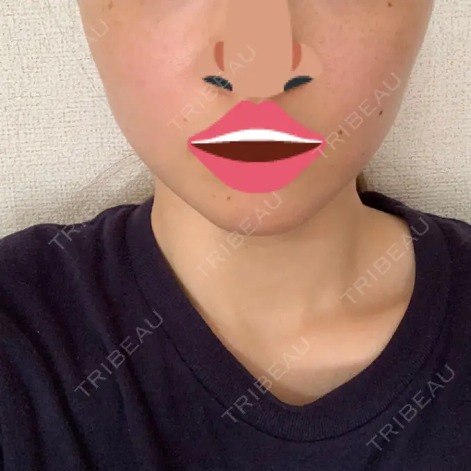 ボトックス（エラ・小顔） 品川スキンクリニック心斎橋院 DAY 5 メイン用