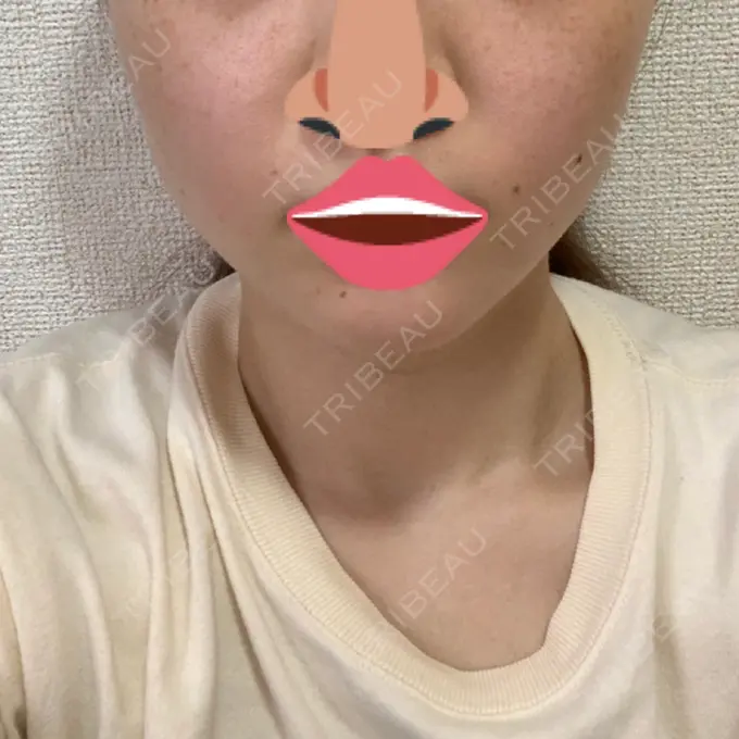 ボトックス（エラ・小顔） 品川スキンクリニック心斎橋院 DAY 8 メイン用