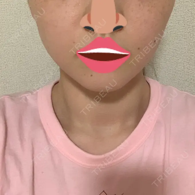 ボトックス（エラ・小顔） 品川スキンクリニック心斎橋院 DAY 12 メイン用