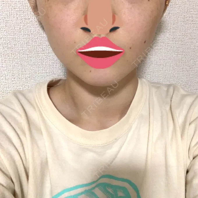 ボトックス（エラ・小顔） 品川スキンクリニック心斎橋院 DAY 21 メイン用