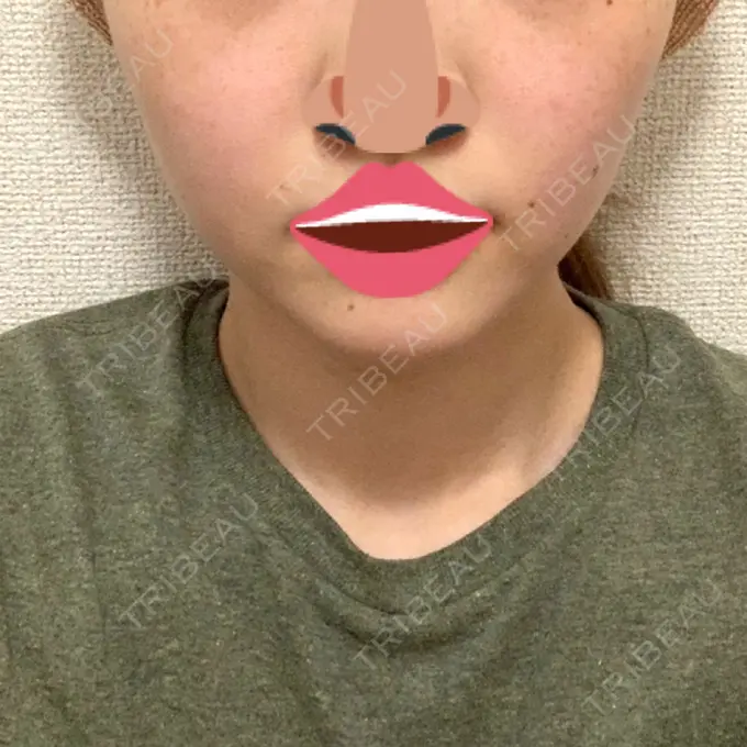 ボトックス（エラ・小顔） 品川スキンクリニック心斎橋院 DAY 16 メイン用