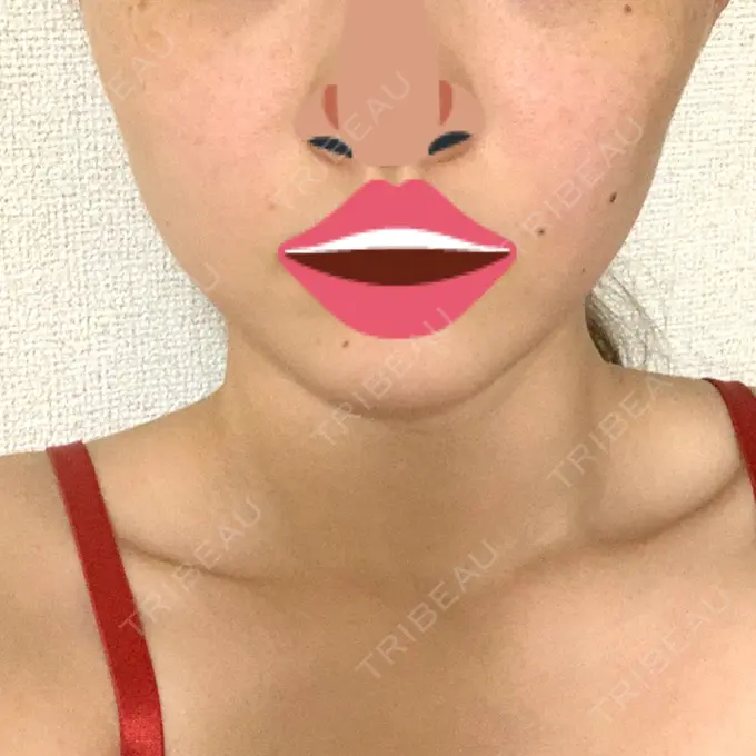 ボトックス（エラ・小顔） 品川スキンクリニック心斎橋院 DAY 24 メイン用