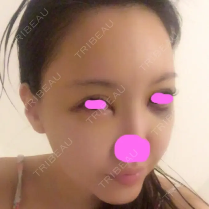 脂肪注入（輪郭） シンデレラ美容整形外科 DAY 4 メイン用