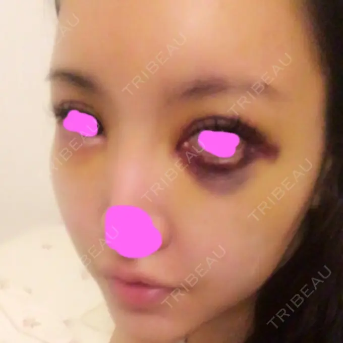 脂肪注入（輪郭） シンデレラ美容整形外科 DAY 4 メイン用