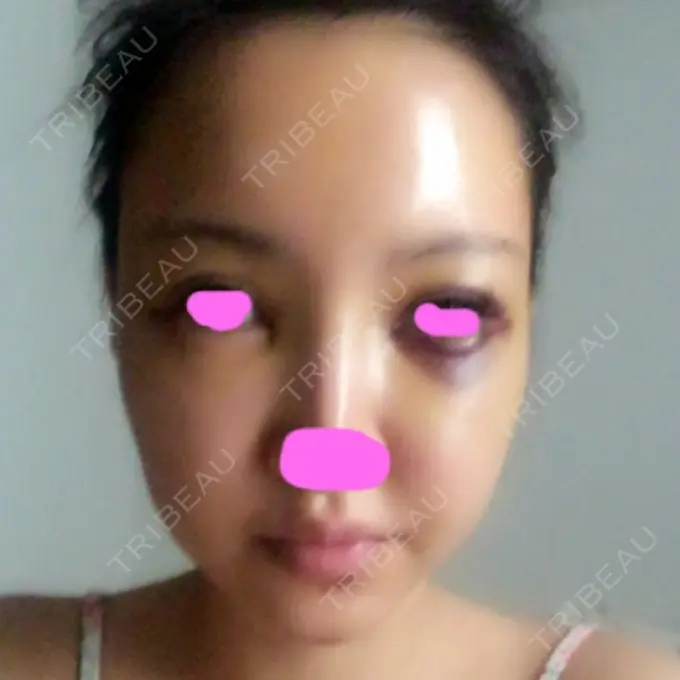 脂肪注入（輪郭） シンデレラ美容整形外科 DAY 4 メイン用