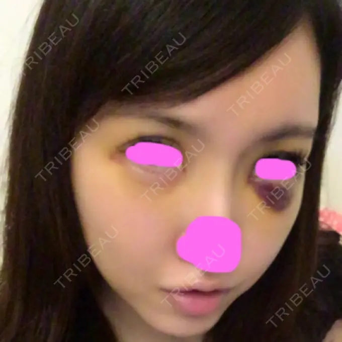 脂肪注入（輪郭） シンデレラ美容整形外科 DAY 10 メイン用