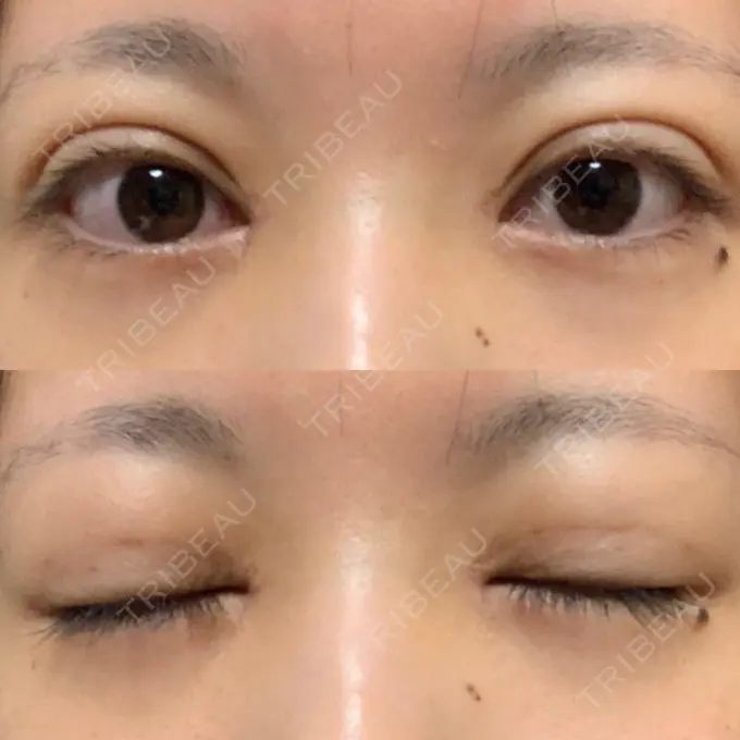 二重埋没 / 目頭切開 / 眼瞼下垂（切開） / その他（目元） 湘南美容クリニック 仙台院 DAY 23 メイン用