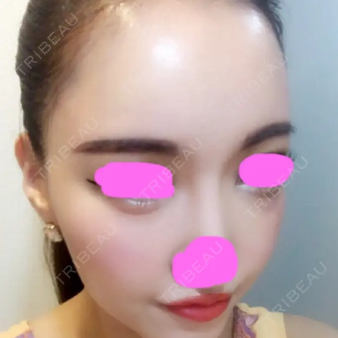 脂肪注入（輪郭） シンデレラ美容整形外科 AFTER メイン用