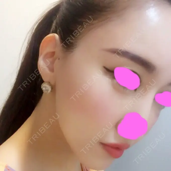 脂肪注入（輪郭） シンデレラ美容整形外科 DAY 15 メイン用