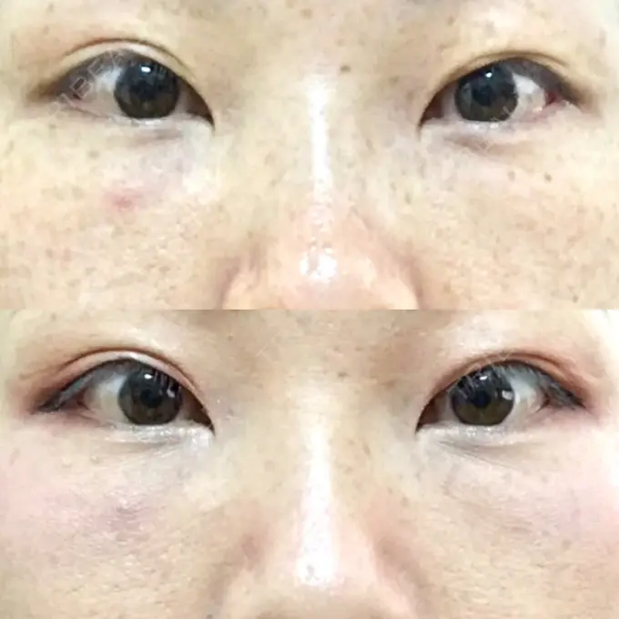 下まぶたたるみ取り / 下まぶたの脂肪取り 韓国ST美容整形外科 DAY 62 メイン用