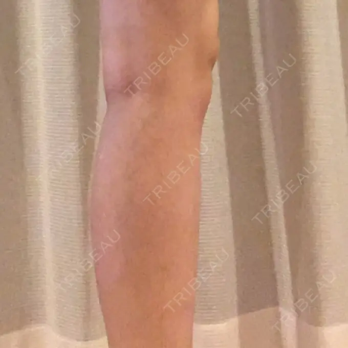 その他（ボディ） アサミ美容外科 渋谷院 DAY 14 メイン用