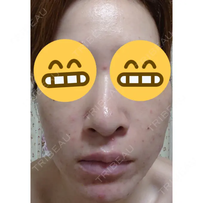 ほくろ・いぼ除去レーザー（肌） 広島プルミエクリニック AFTER メイン用