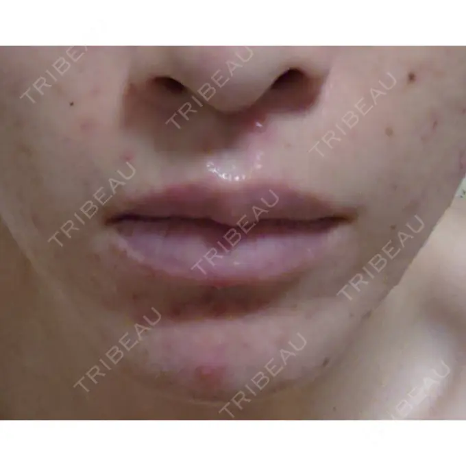 脂肪注入（肌） 広島プルミエクリニック AFTER メイン用