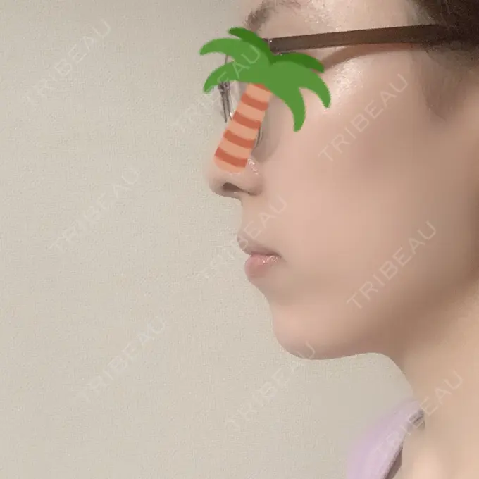 ボトックス（あご） / ヒアルロン酸注入（あご） / ボトックス（エラ・小顔） TCB東京中央美容外科 新宿東口院 DAY 26 メイン用