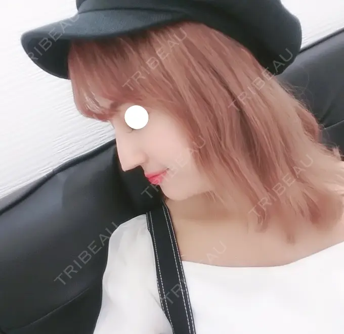 鼻尖形成（切開） TCB東京中央美容外科 渋谷西口院 AFTER メイン用