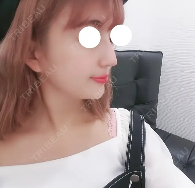 鼻尖形成（切開） TCB東京中央美容外科 渋谷西口院 DAY 38 メイン用