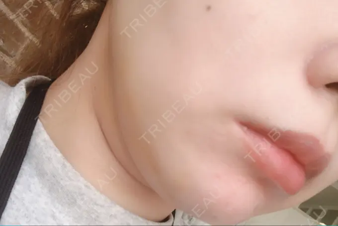 二重埋没 / 糸リフト / 脂肪吸引（顔） / ボトックス（あご） / ヒアルロン酸注入（あご） TCB東京中央美容外科 新宿東口院 DAY 4 メイン用