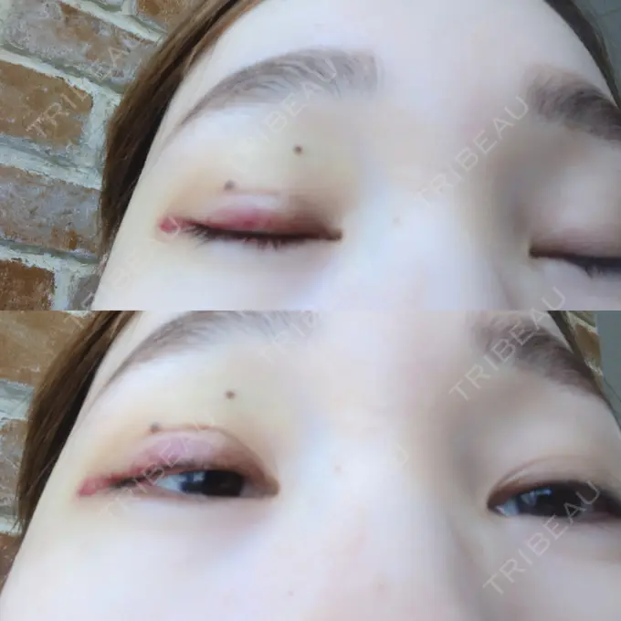 二重埋没 / 糸リフト / 脂肪吸引（顔） / ボトックス（あご） / ヒアルロン酸注入（あご） TCB東京中央美容外科 新宿東口院 DAY 4 メイン用