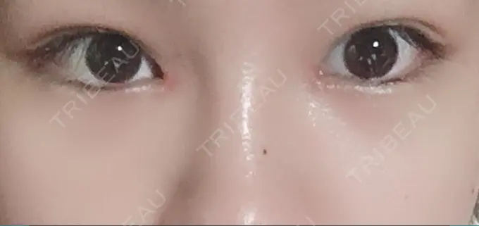 目頭切開 / 目尻切開 / ヒアルロン酸注入（鼻） 麹町皮ふ科・形成外科クリニック AFTER メイン用