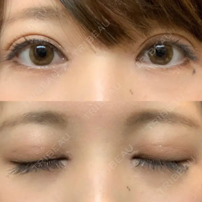二重埋没 / 目頭切開 / 眼瞼下垂（切開） / その他（目元） 湘南美容クリニック 仙台院 AFTER メイン用